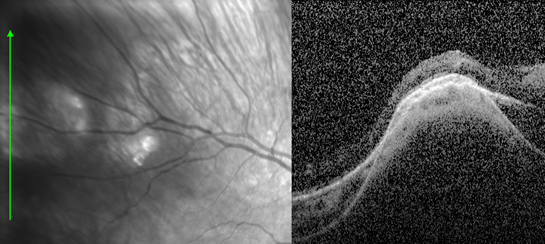 Figure 5: EDI-OCT of the right eye table mountain pattern.