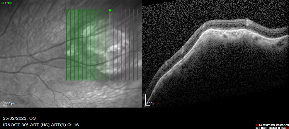 Figure 6: EDI-OCT of the left eye rolling pattern.