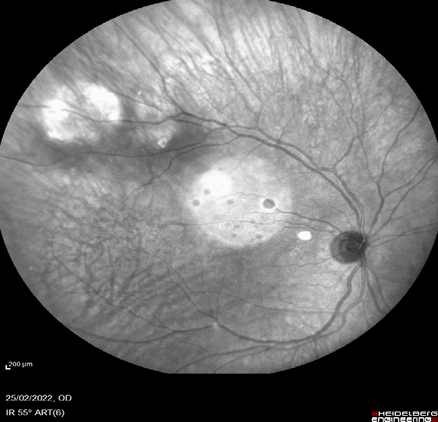 Figure 7: Fundus auto fluorescence of the right eye annular pattern.