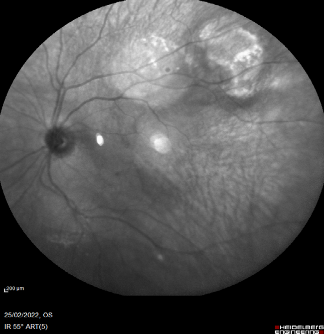 Figure 8: Fundus auto fluorescence of the left eye bright speckles.