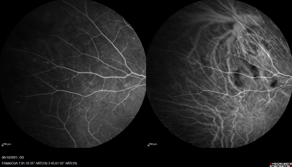 Figure 9: Fluorescein angiography and Indocyanine green angiography of the right eye.