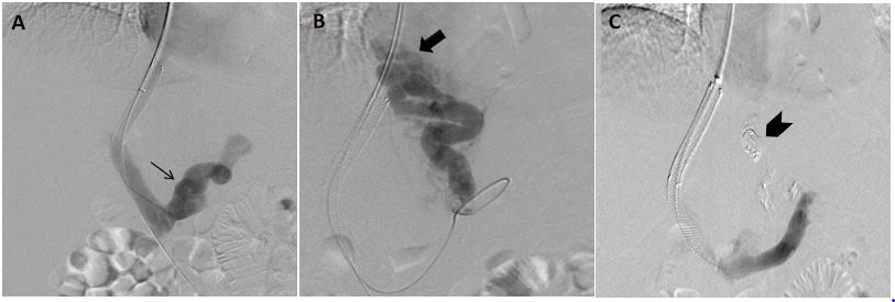 Figure 1: These are uphill varices and bleeding from these varices can be attributed to high portal pressure (Wall Tension = Pressure x Radius of vessel). Reduction of portal pressure (placement of a TIPS stent) may be sufficient for controlling refractory bleed from these varices.