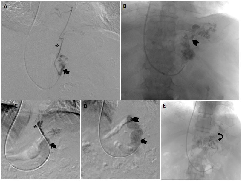 Figure 3: Retrograde obliterated venogram and obliteration done in two patients with acute gastric variceal bleeding with endoscopy suggestive of large type 2 gastro esophageal varices (GOV-2). A,B) A small diameter collateral vein (arrow) was seen arising from the large gastro renal shunt (block arrow) suggestive of a type B1 efferent anatomy. Sclerosant injection was done after advancing the tip of the catheter distal to the origin of the collateral vein. C,D,E) In a different patient, a large diameter collateral vein (arrow) was seen arising from the gastro renal shunt (block arrow) suggestive of a type B2 efferent anatomy. Coil embolization (arrowhead) of the collateral vein was done prior to injection of sclerosant (curved arrow). These modified BRTO techniques are time consuming and have increased chances of non-target systemic sclerosant embolization. [BRTO = Balloon occluded retrograde transvenous obliteration].