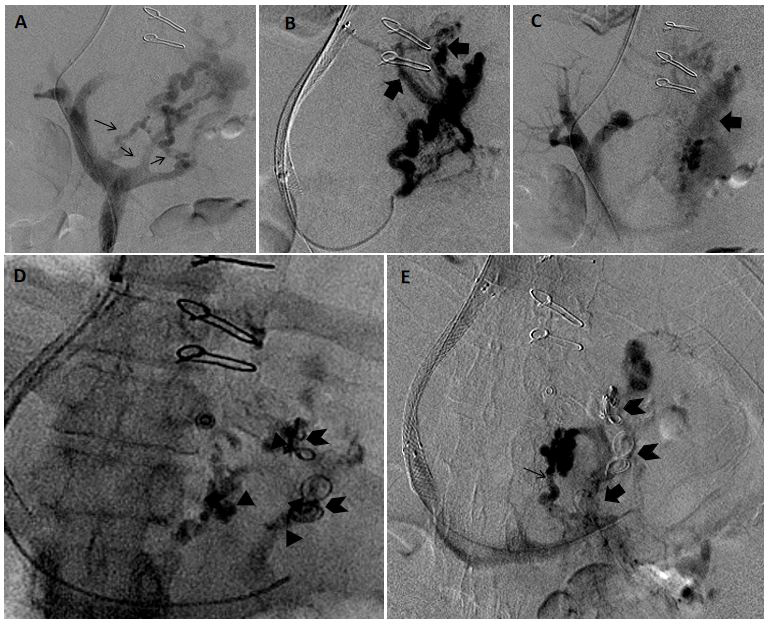 Figure 4: A patient with active variceal bleeding with endoscopy suggestive of large type 2 gastroesophageal varices (GOV-2). A) Antegrade splenoportography images depicted the predominant afferent supply of the gastric varices from left gastric vein (LGV), posterior gastric vein (PGV) and short gastric vein (SGV) (arrows). B,C) The efferent drainage of the varices were via a large gastro renal shunt as well as large collateral veins (block arrows). A type B3 efferent anatomy increases the chances of systemic non-target embolization of sclerosants during conventional BRTO. D) Embolization of the afferents was done using multiple coils (arrowhead) and glue (triangle). E) Post TIPS post embolization splenoportogram showed non opacification of gastric varices. However, a smaller afferent (arrow) was seen arising directly from the splenic vein and draining directly into and opacifying the gastro renal shunt. This was suggestive of a type 3 afferent anatomy. A type 3 afferent anatomy has increased chances of embolization of sclerosant into the portal vein during retrograde obliteration. [TIPS = Transjugular Intrahepatic Portosystemic Shunt].