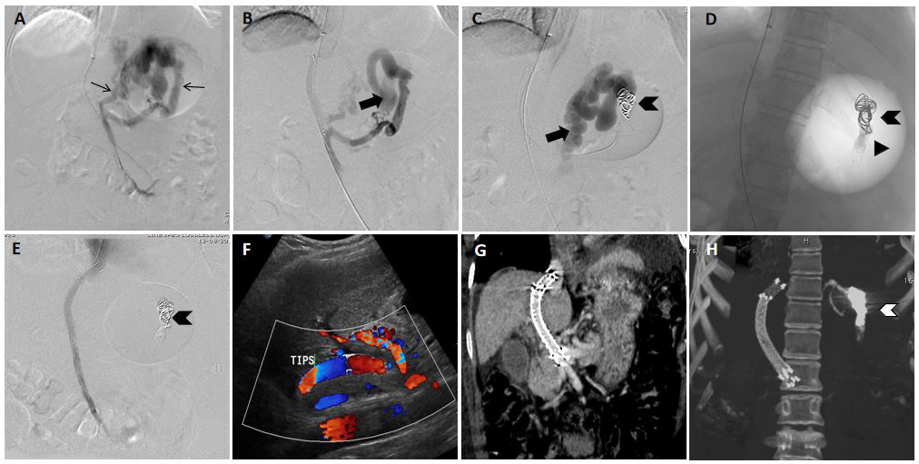 Figure 5: A patient with active variceal bleeding with endoscopy suggestive of large type 2 gastroesophageal varices (GOV- 2). A) Antegrade splenoportography images depicted the predominant afferent supply of the gastric varices from left gastric vein (LGV), posterior gastric vein (PGV) and short gastric veins (SGV) (arrows) suggestive of a type 2 afferent anatomy. A type 2 afferent anatomy may have persistence of flow into the gastric varices after retrograde obliteration B) Efferent drainage of the varices was via a large gastrorenal shunt (GRS) (type A efferent anatomy) C) Post coil (arrowhead) deployment splenoportography images show persistent opacification of gastric varices and gastro renal shunt (block arrow). D) Spot image post glue embolization showing glue cast proximal to the deployed coil. E) Post glue and coil deployment portography images show no contrast opacification of gastric varices. F,G,H) Follow up Doppler and CECT scan after one month shows normal flow and contrast opacification of the stent. Note the coil and glue cast (white arrowhead).