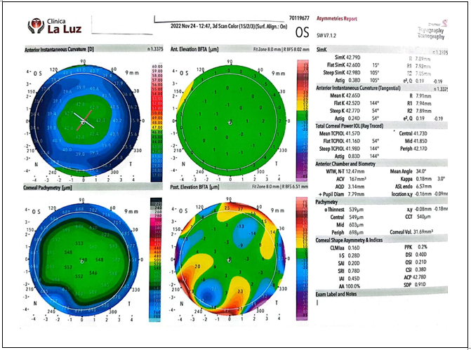 Figure 1: LE preoperative corneal topography.