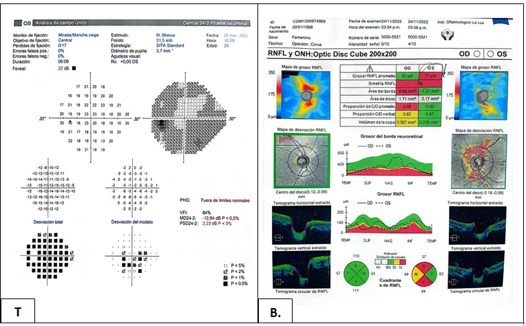Figure 4: A) Computerized visual field 24/2 preoperative OI. B) OCT of the preoperative LE optic nerve.