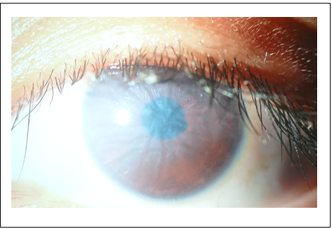 Figure 5: Post-operative day 1 of the ICL implant in LE.