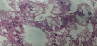 Figure 5: Showing the Occlusion of the Hepatopancreatic Cell Infected with Bacteria in Penaeus monodon.