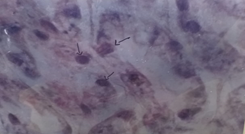 Figure 6: Showing Hypertrophic Intranucluear Inclusion Bodies in the Hepatopancreatic Secretory Cells in Infected Prawn Penaeus monodon.