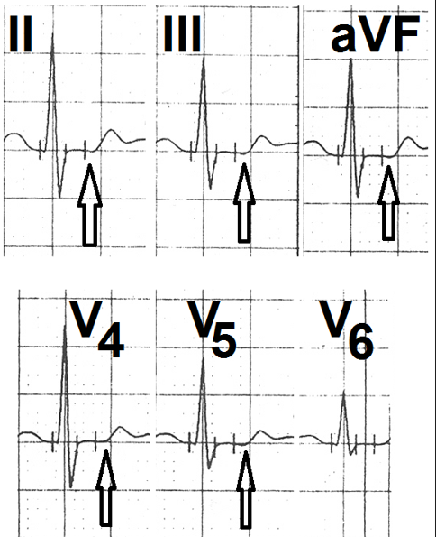 Figure 1: Leads II, III, aVF, V4, V5 and V6 showing horizontality of the ST-segment with sharp angled ST segment - T wave junction (marked as ↑).