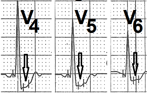 Figure 2: Leads V4, V5 and V6 showing slow upsloping ST-segment depression (marked as ↓).
