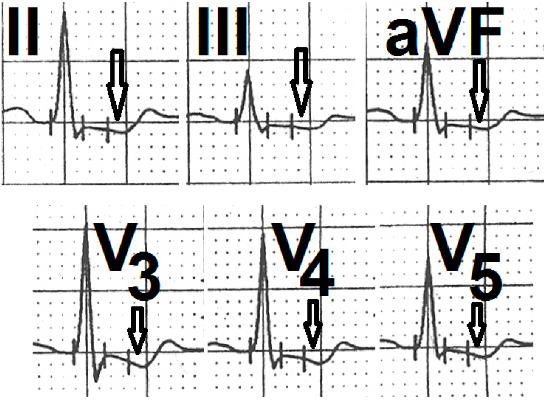 Figure 4: Leads II, III, aVF, V4, V5 and V6 showing horizontal ST-segment depression of more than 2mm (marked as ↓).