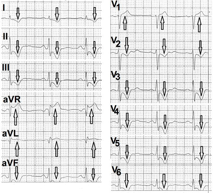 Figure 7: Electrocardiogram recorded at the end of third minute of recovery showing heart rate of 66 beats per minute. There is downsloping ST-segment depression in leads I, II, III, aVF, V2, V3, V4, V5 and V6 (marked as ↓) with ST-segment elevation is leads aVR, aVL and V1 (marked as ↑).