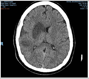 Figure 4: Axial CT-B on day 2; maturation of the infarct.