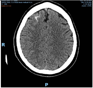 Figure 5: Axial CT-B on day 2; streak of SAH.