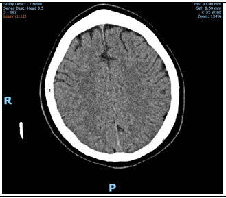 Figure 7: Axial CT-B on day 5; resolution of SAH.