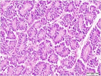 Figure 1: Pancreatic neuroendocrine tumour demonstrating gyri, cords, festoons, glandular articulations and pseudo-acinar structures of neuroendocrine cells with moderate amphophilic cytoplasm, regular nuclei with finely stippled chromatin and inconspicuous nucleoli. Circumscribing stroma is scanty and vascularized [4].