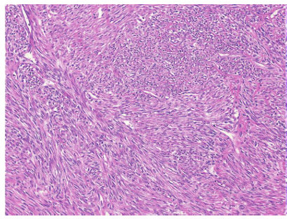 Figure 1: Microscopic view of leiomyoma.