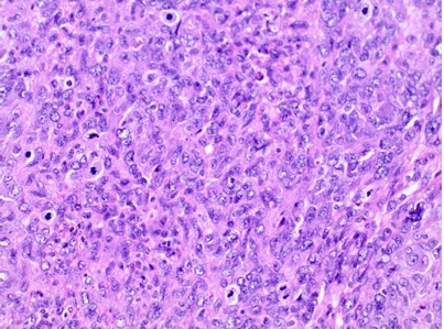 Figure 2: Microscopic view of leiomyosarcoma.