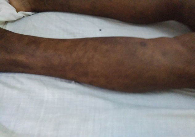 Figure 1: Dermatological reactions three months after administration of the second dose of the vaccine.