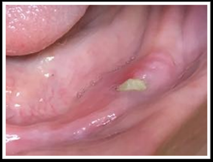 Figure 2: Female patient 34 years old. Diagnosis of breast cancer with bone metastases. Consume Zoledronate 4.0 mg/ every 21 days. Tooth extraction, with bone exposure, exposed mylohyoid line, and pain.