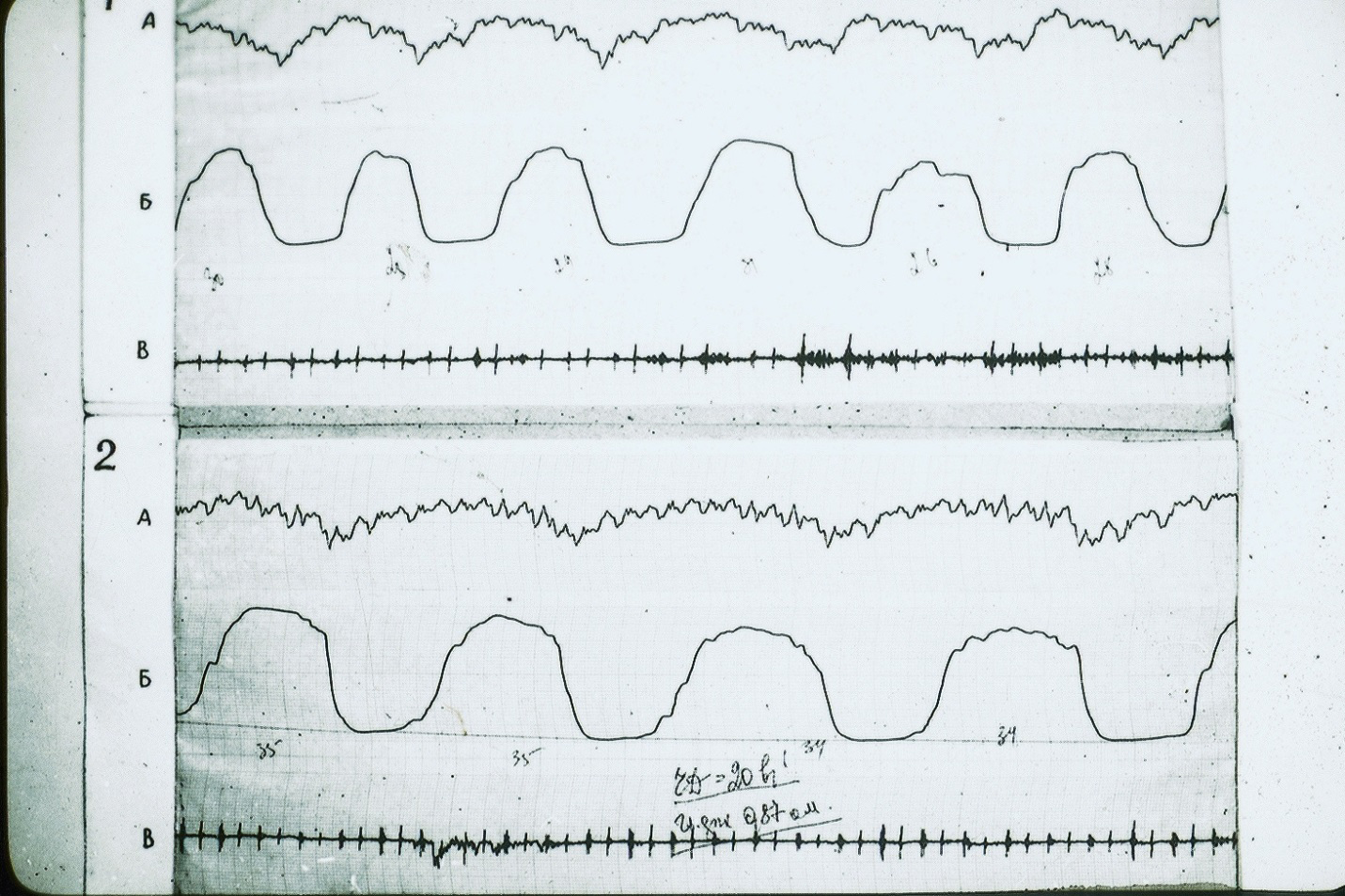 Figure 1: Rheogram of ventilation of the patient 8 years old, AP 7-10 segments of the right lung. • The original reopulmonography (RPG). • 2-RPG after vagosympathetic blockade • A-differential RPGs • Б-Main RPG • В-phonocardiogram
