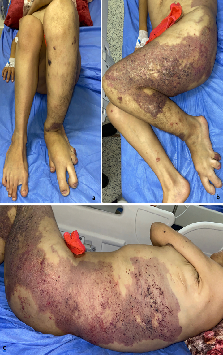Figure 1: Hypertrophy of the left lower limb with macrodactyly of the 2nd and 3rd toes (a) and the presence on the same side of a macular angiomatous placard predominantly hemicorporeal (b and c), dotted with lymphangiectasias.