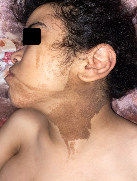 Figure 3: Linear verrucous epidermal nevus of the neck, cheek and chin on the left side.
