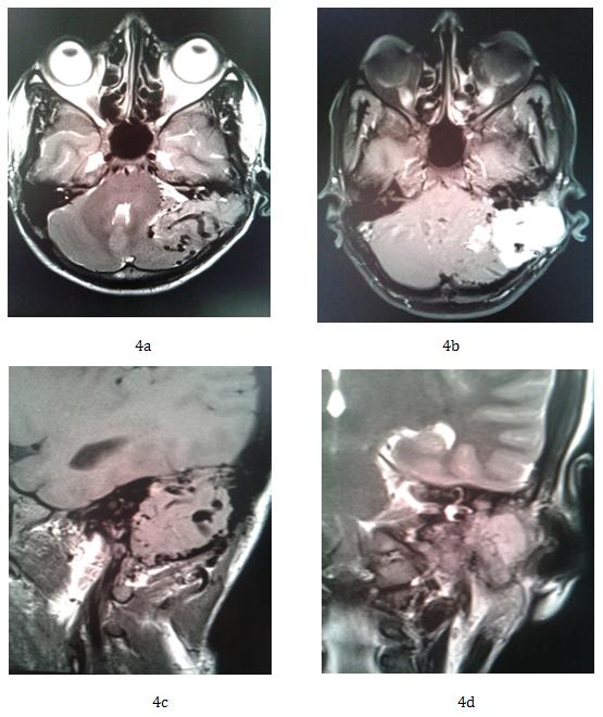 Figure 3: Doppler ultrasound of mastoid shows the vascularity of the tumor.