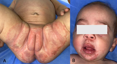 Figure 1: Well-defined scaly erythematous lesions in the genital-crural (A) and perioral (B) areas.