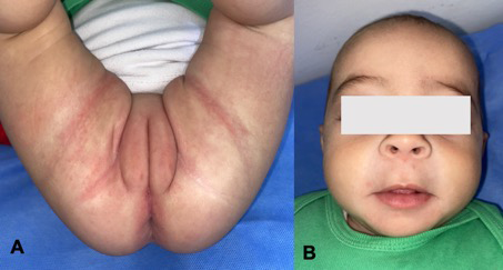Figure 2: Clinical presentation one month after the beginning of the zinc supplementation: total disappearance of genital- crural (A) and perioral (B) lesions.