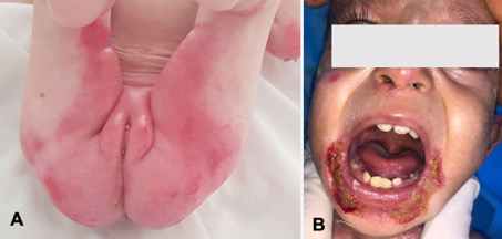 Figure 3: Erythematous and erosive crusted lesions in the genital-crural (A) and perioral (B) areas in an infant with hereditary epidermolysis bullosa.