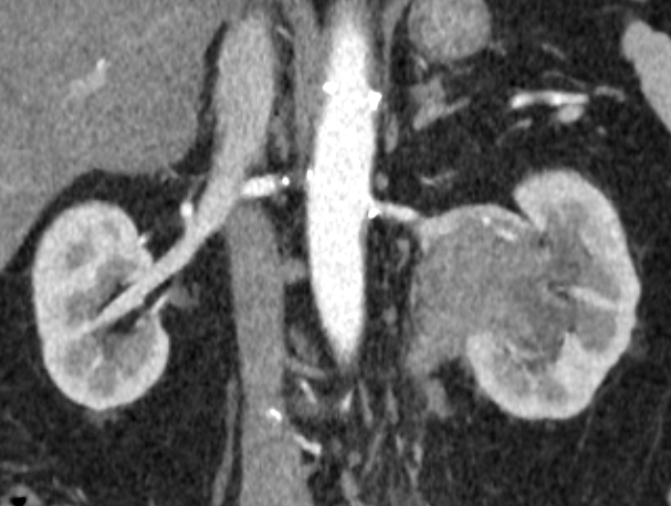 Figure 1: Coronal Images of CT Intravenous pyelogram, arterial phase, demonstrating a slightly enhancing left upper tract collecting system/renal mass.