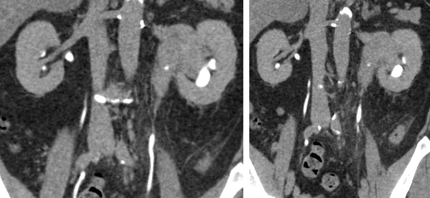 Figure 2: Coronal images of CT Intravenous Pyelogram, delayed phases, demonstrating large filling defect or extrinsic compression of the left renal collecting system.