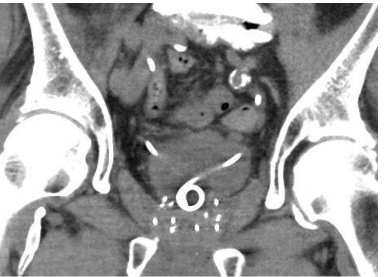 Figure 2: Computed tomography (CT) of the abdomen and pelvis. Cross-sectional coronal imaging using computed tomography (CT) of the abdomen and pelvis with IV contrast shows marked hypertrophy of the prostate with overgrowth of the ureteral stents, as well as prior brachytherapy seeds.