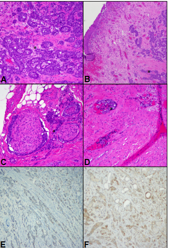 Figure 3: The biopsy and resection specimens from patient 2 exhibited anastomosing nests of hyperchromatic, basaloid cells, marked with asterisk (A), in some areas closely approaching urothelial mucosa (B). Peri-neural invasion was pervasive and involved several large-caliber nerves (C). Lymphovascular invasion was prominent, in some fields involving several adjacent blood vessels (D). Tumor cells had moderate nuclear positivity with p63 in the outermost cells (E) and cytoplasmic bcl-2 positivity (F).