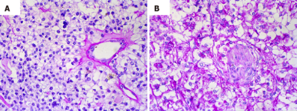 Figure 2: Hyalinising clear cell carcinoma enunciating cords, nests or trabeculae of tumour cells incorporated with clear cytoplasm. Circumscribing stroma is dense, hyalinised, hypo-cellular with adjoining desmoplastic and myxoid stroma [8].