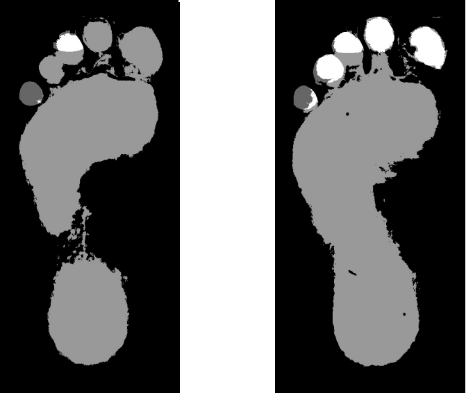 Figure 5: Plantar image (white areas are finger-ground surfaces).