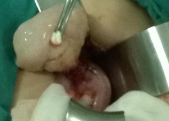 Figure 1: Intraoperative mass image.