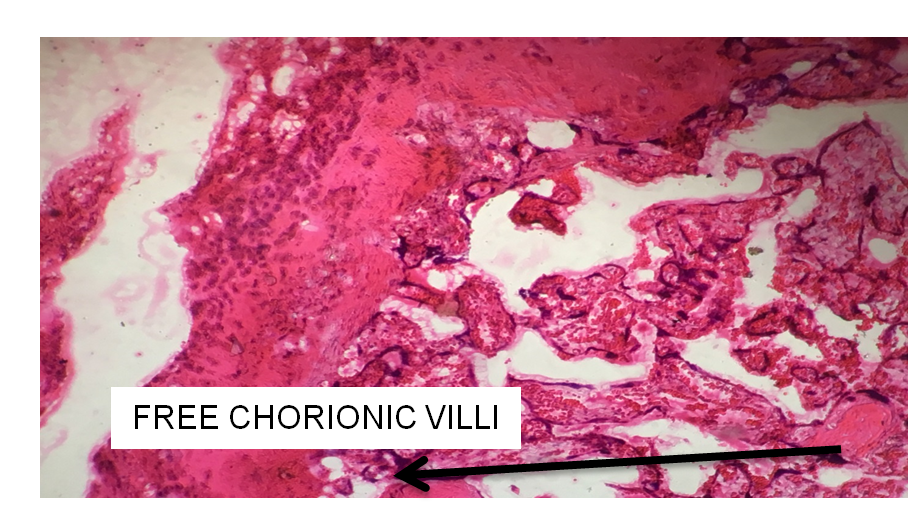 Figure 1: Slide of Placenta showing free chorionic villi.