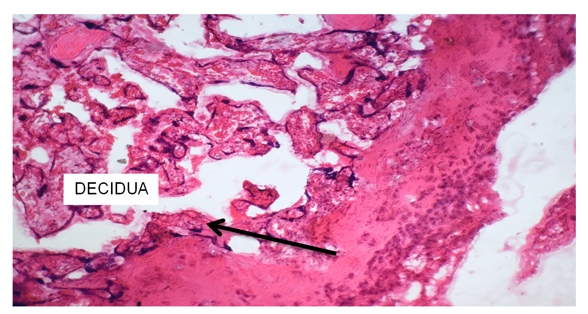 Figure 2: Slide of Placenta showing Decidua.