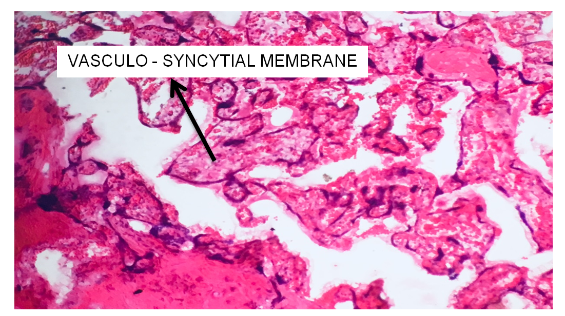 Figure 3: Slide placenta showing Vasculo - syncytial membrane.