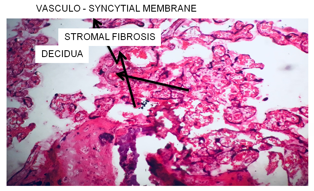 Figure 7: Slide of Placenta showing Syncytial Knots.