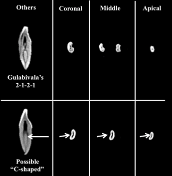 Figure 2: Representative image of root canal variations seen in permanent mandibular central and lateral incisors evaluated in current study according to Vertucci’s classification. The type I, II, III and IV at coronal, middle and apical third are presented.