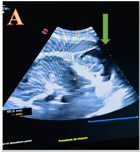 Figure 1: Neonatal Retrognatism Aspect Figure 2: Posterior Encephalocele Aspect