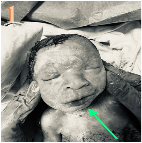 Figure 4: Clubfoot Aspect with Associated Polydactyly.