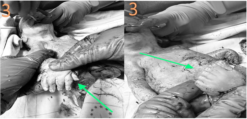 Figure 5: Cleft Palate Aspect.