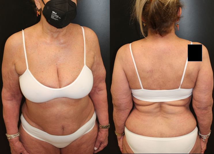 Figure 2: After 4 weeks of association dupilumab- guselkumab.