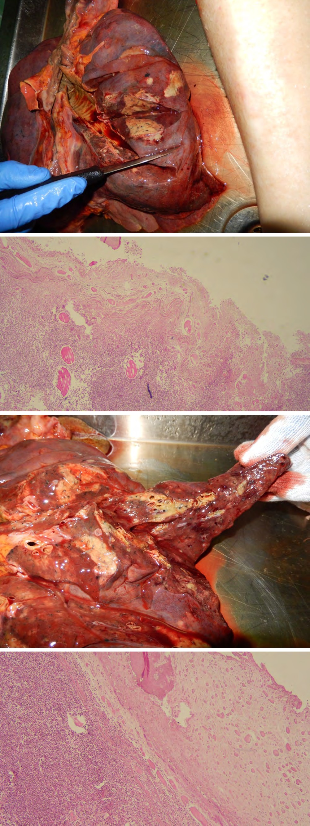 Figure 3: Injury to the Larynx. In The Subglottic Region, a Rounded Lesion Caused by the Spray of Caustic Substance is Evident.